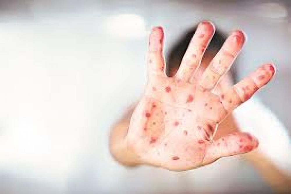 Secretaria de Saúde relembra importância da vacinação do sarampo